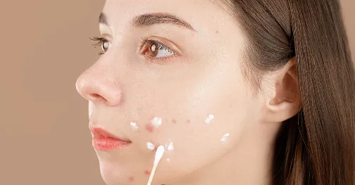 Miếng Dán Mụn Hay Gel Chấm Mụn? Nhìn Nốt Mụn Vài Giây Là Biết Nên Dùng Cái Nào