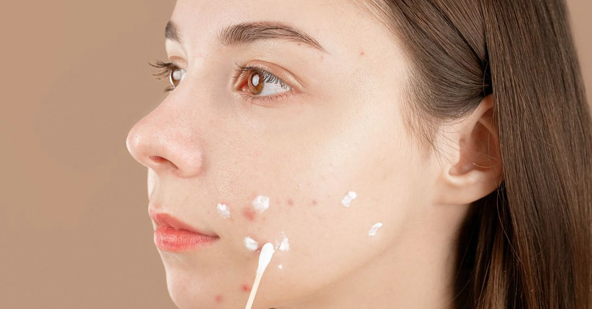 Miếng Dán Mụn Hay Gel Chấm Mụn? Nhìn Nốt Mụn Vài Giây Là Biết Nên Dùng Cái Nào