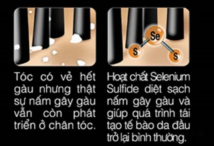 Dầu gội loại bỏ gàu, nấm, ngứa da đầu Selsun Selenium Sulfide 2.5% 120ml Thái Lan ảnh 4
