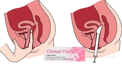 Viên nhiễm phụ khoa Clomaz-Forte Thái Lan ảnh 7