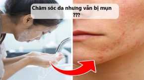 5 sai lầm khi chăm sóc da có thể gây ra mụn