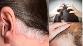 Bệnh vảy nến da đầu có lây không, có điều trị được không?