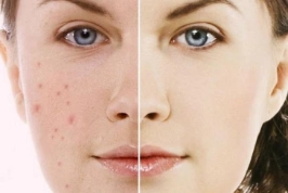 Bật mí cách chăm sóc da bị sẹo mụn hiệu quả tại nhà