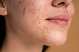 Mọc mụn ở cằm do đâu? 6 cách trị mụn cằm cực kỳ hiệu quả
