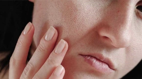 Giải cứu làn da mất cân bằng dầu nước với 6 mẹo đơn giản