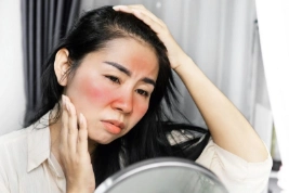 Cách làm dịu da khi cháy nắng nhanh chóng tại nhà, hiệu quả tức thì!