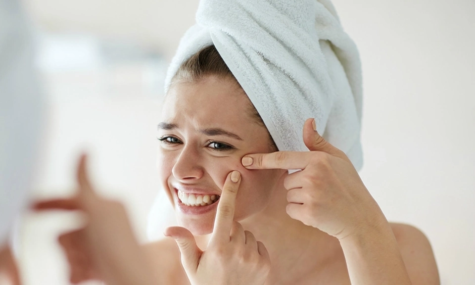 Ảnh bài viết Cách nặn mụn an toàn tại nhà, không sưng không sẹo