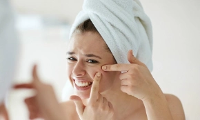Cách nặn mụn an toàn tại nhà, không sưng không sẹo