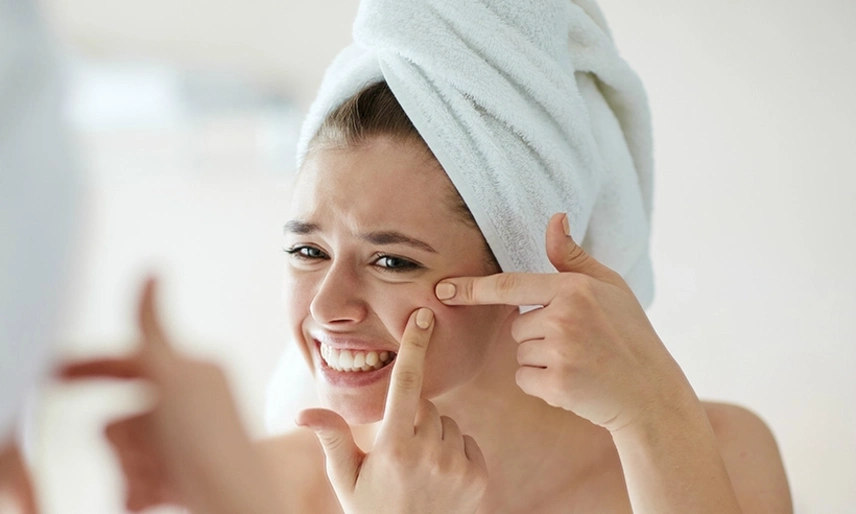 Cách nặn mụn an toàn tại nhà, không sưng không sẹo