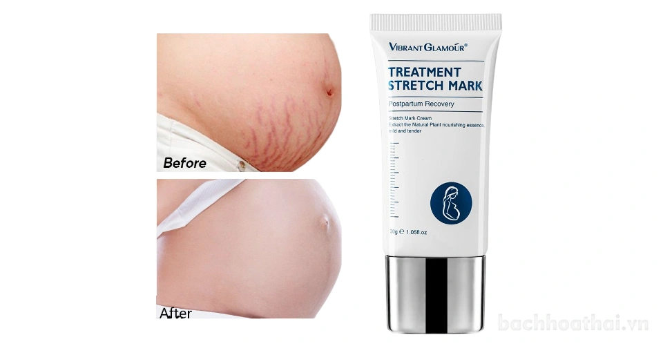 Kem làm mờ sẹo, rạn da Vibrant Glamour Treatment Stretch Mark