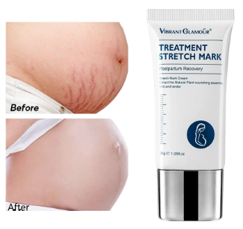 Ảnh sản phẩm Kem làm mờ sẹo, rạn da Vibrant Glamour Treatment Stretch Mark 1