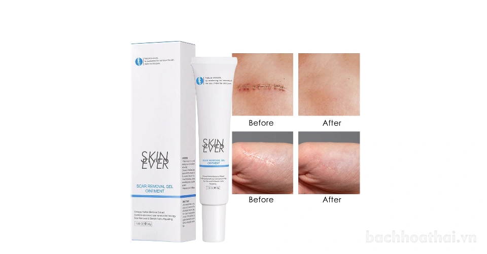 Gel cải thiện Sẹo SKIN EVER Scar Removal Gel Ointment chiết xuất thảo dược phục hồi da