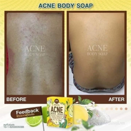 Xà phòng trị mụn trắng da toàn thân Beauty 4 Secret Acne Body Soap ảnh 9