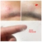 Miếng dán mụn Lanbena Acne Pimple Patch ảnh 9