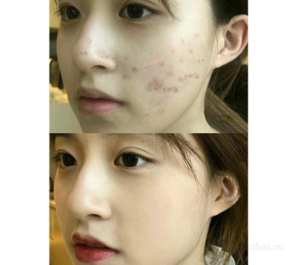 Sữa rửa mặt ngừa mụn trắng da Hatomugi Acne Care & Facial Washing ảnh 9