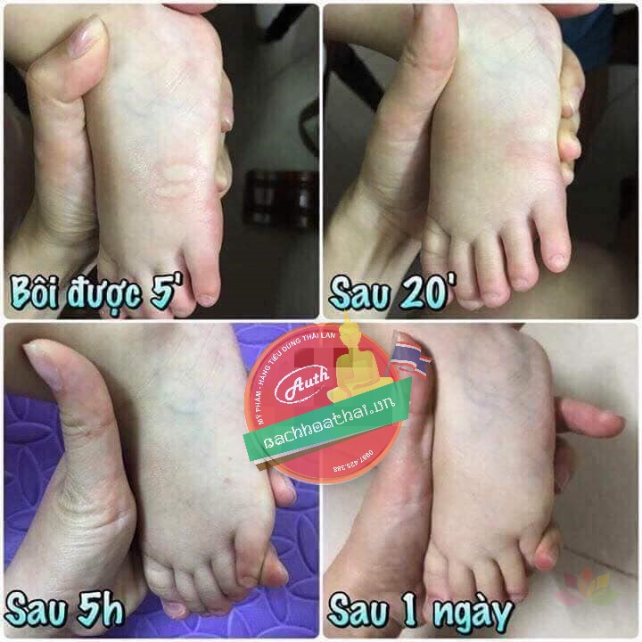 Dầu bôi trị muỗi đốt Yanhee Green Balm Mosquito Brand ảnh 5