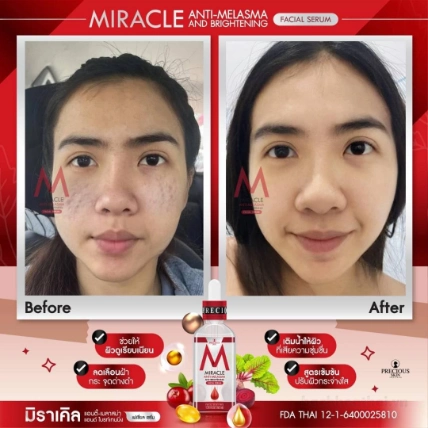 Serum trị nám dưỡng trắng da Miracle Anti-Melasma and Brightening Facial ảnh 3