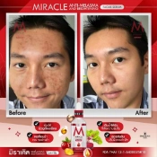 Ảnh sản phẩm Serum trị nám dưỡng trắng da Miracle Anti-Melasma and Brightening Facial 2