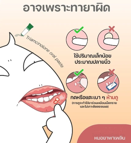 Kem trị nhiệt miệng Trinolone Oral Paste ảnh 2