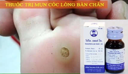 Thuốc bôi trị mụn cóc, sùi mào gà Podophyllin Paint 25% Thái Lan ảnh 4