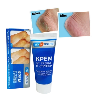 Ảnh sản phẩm Kem dưỡng nứt gót chân Kpem OT Tpewnh B Ctynhrx Nga 1