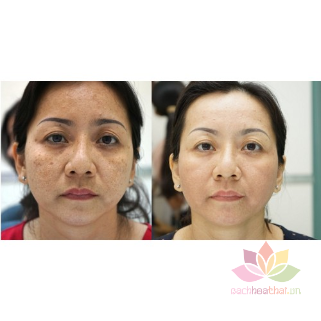 Bộ trị thâm mụn dưỡng trắng da Yanhee Xanh lá ảnh 10