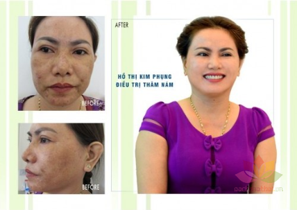 Bộ trị mụn nám tàn nhang Yanhee Cherry đỏ ảnh 6