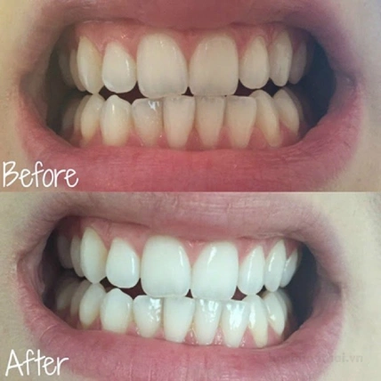 Bộ kem đánh răng thảo dược thơm miệng trắng răng Herbal Clove Toothpaste + Coconut Toothpaste ảnh 12