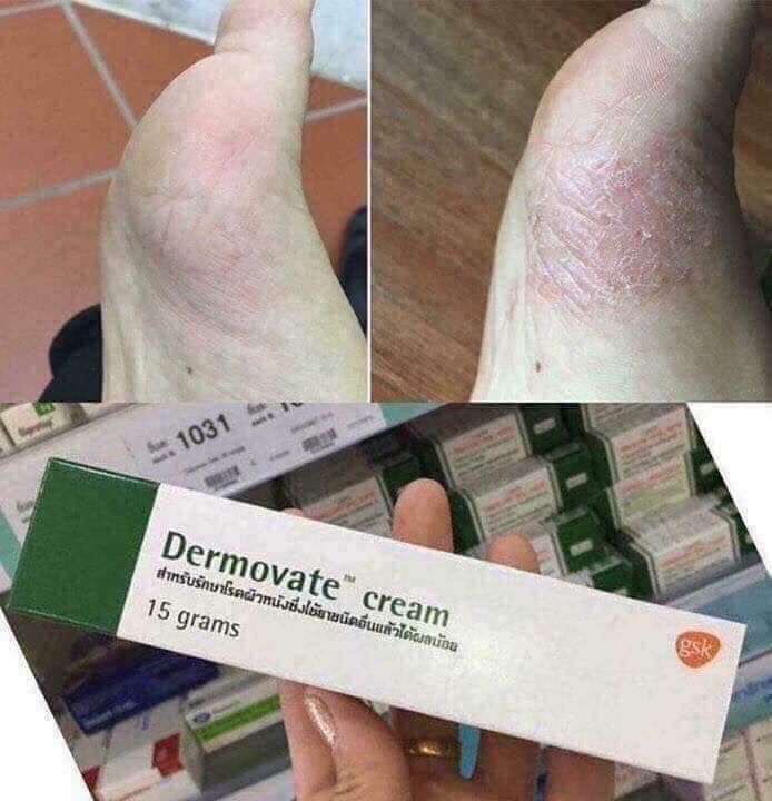 Kem trị chàm vảy nến Dermovate Cream