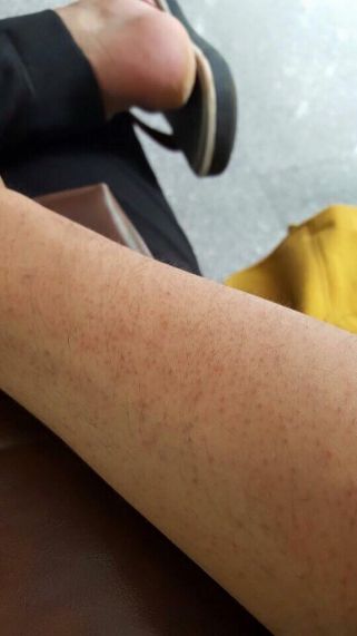 Kela Lotion đặc trị viêm lỗ chân lông ảnh 4
