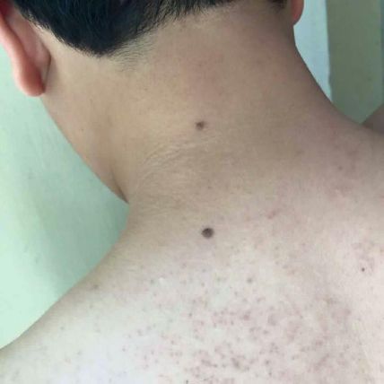 Kela Lotion đặc trị viêm lỗ chân lông ảnh 5
