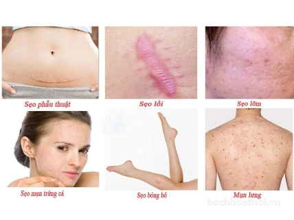 Kem trị sẹo thâm mắt rạn da cấp tốc Klirvin Nga ảnh 10
