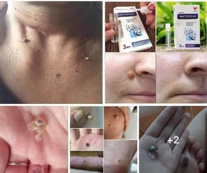 Gel tẩy nốt ruồi mụn thịt, mụn cóc Dvelinil của Nga ảnh 6