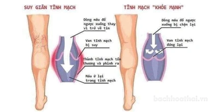 Kem bôi suy giãn tĩnh mạch Varikosette Cream For Legs ảnh 4