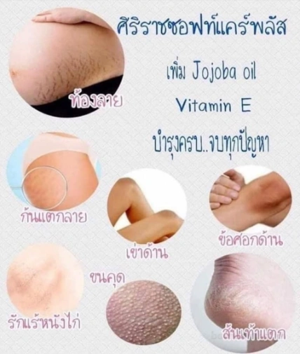 Kem trị sẹo rạn da Siriraj Soft Care Plus Thái Lan ảnh 8