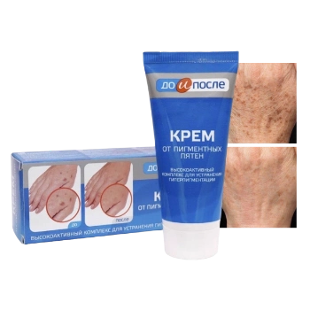 Ảnh sản phẩm Kem dưỡng trị đồi mồi tay chân Nga Kpem  1