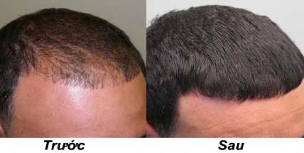 Cặp xịt kích mọc tóc chanh Hair Lon Beauty ảnh 12